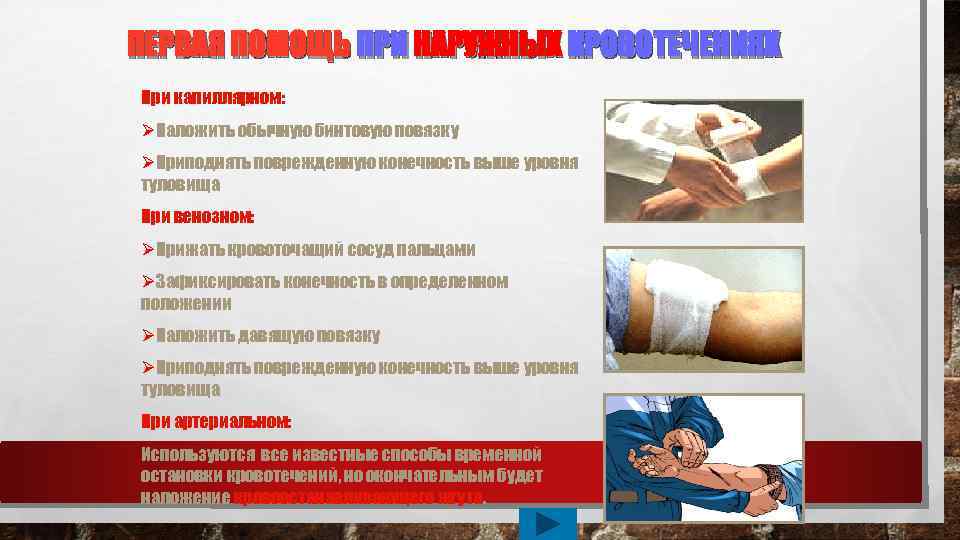 ПЕРВАЯ ПОМОЩЬ ПРИ НАРУЖНЫХ КРОВОТЕЧЕНИЯХ При капиллярном: ØНаложить обычную бинтовую повязку ØПриподнять поврежденную конечность