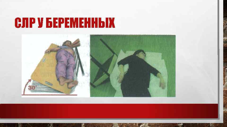 СЛР У БЕРЕМЕННЫХ 