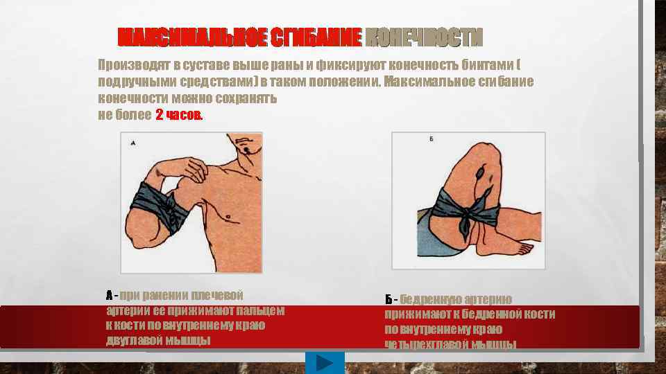 МАКСИМАЛЬНОЕ СГИБАНИЕ КОНЕЧНОСТИ Производят в суставе выше раны и фиксируют конечность бинтами ( подручными