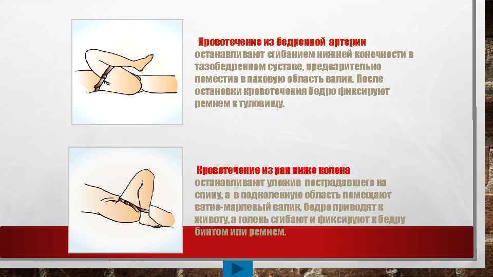 Кровотечение из бедренной артерии останавливают сгибанием нижней конечности в тазобедренном суставе, предварительно поместив в