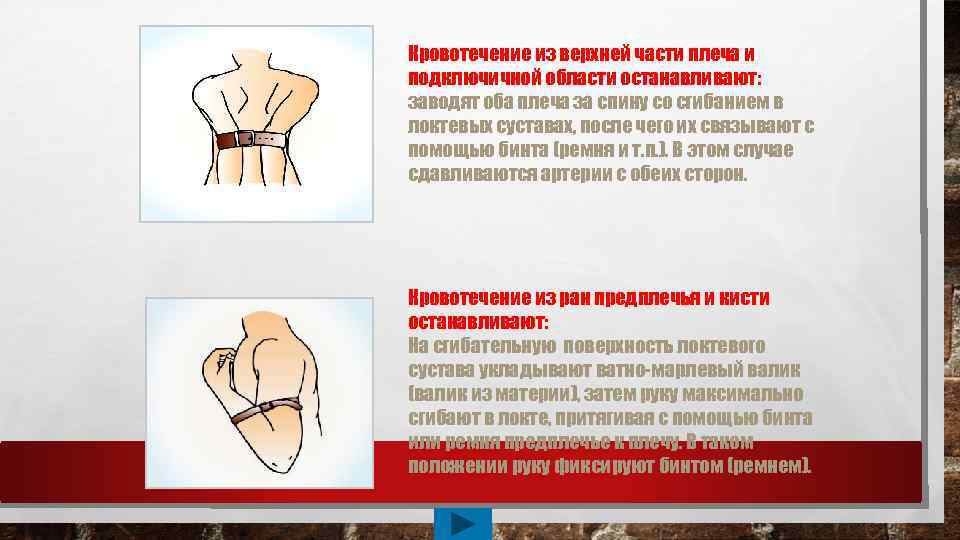 Кровотечение из верхней части плеча и подключичной области останавливают: заводят оба плеча за спину
