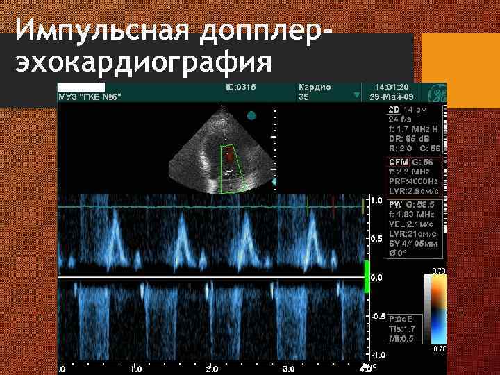 Импульсная допплерэхокардиография 