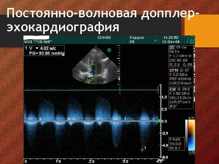 Постоянно-волновая допплерэхокардиография 