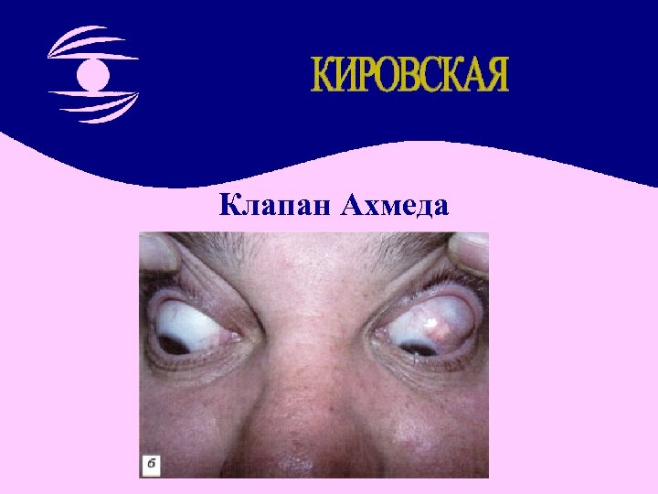 Клапан Ахмеда 