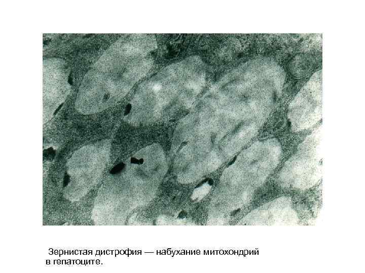  Зернистая дистрофия — набухание митохондрий в гепатоците. 