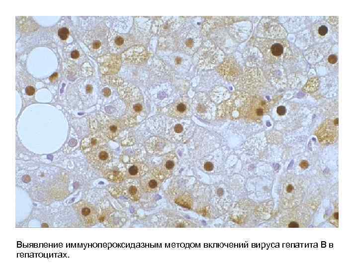 Выявление иммунопероксидазным методом включений вируса гепатита В в гепатоцитах. 