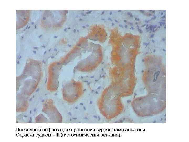 Липоидный нефроз при отравлении суррогатами алкоголя. Окраска судном –III (гистохимическая реакция). 