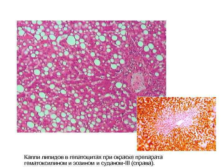 Капли липидов в гепатоцитах при окраске препарата гематоксилином и эозином и суданом-III (справа). 