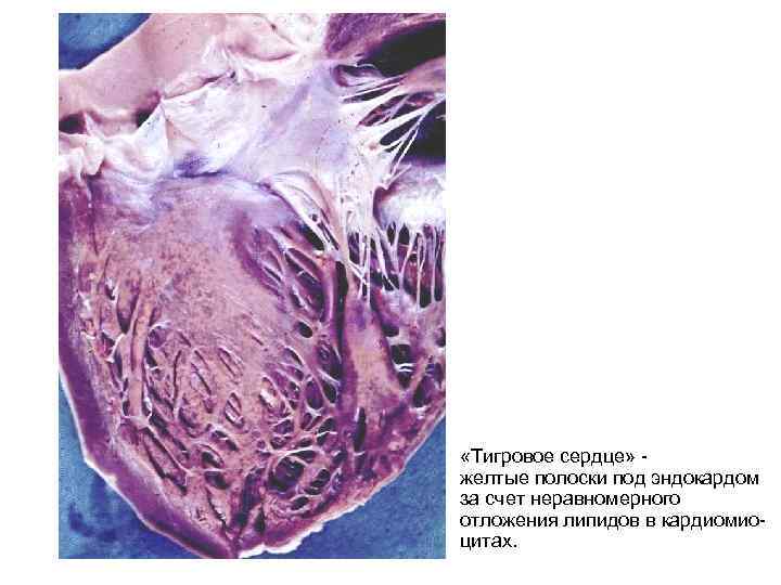  «Тигровое сердце» - желтые полоски под эндокардом за счет неравномерного отложения липидов в