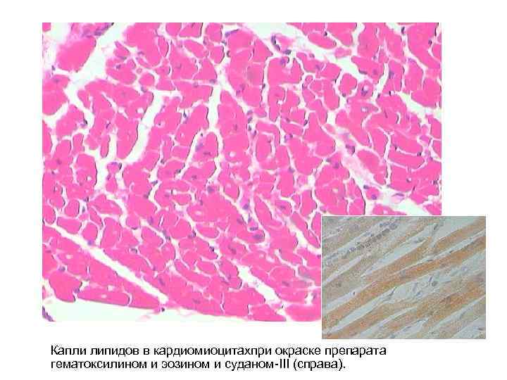 Капли липидов в кардиомиоцитахпри окраске препарата гематоксилином и эозином и суданом-III (справа). 