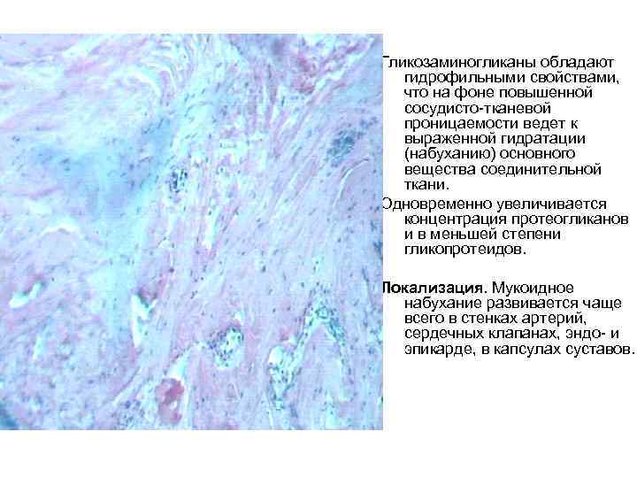 Гликозаминогликаны обладают гидрофильными свойствами, что на фоне повышенной сосудисто-тканевой проницаемости ведет к выраженной гидратации