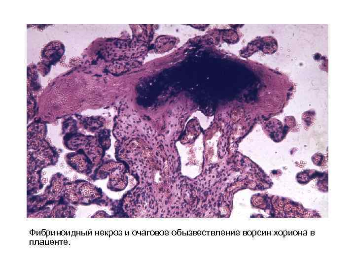Фибриноидный некроз и очаговое обызвествление ворсин хориона в плаценте. 