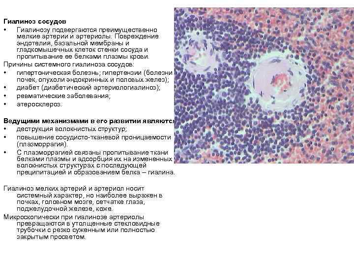 Гиалиноз сосудов • Гиалинозу подвергаются преимущественно мелкие артерии и артериолы. Повреждение эндотелия, базальной мембраны
