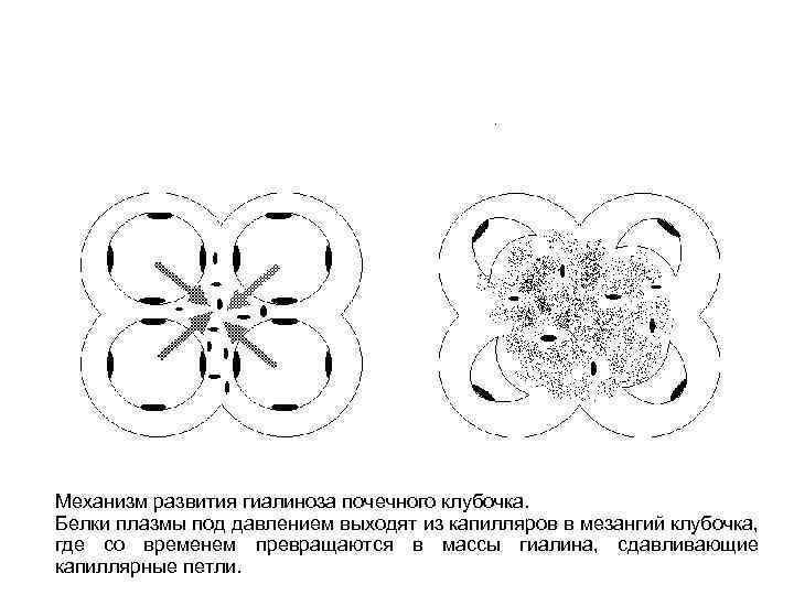 Механизм развития гиалиноза почечного клубочка. Белки плазмы под давлением выходят из капилляров в мезангий