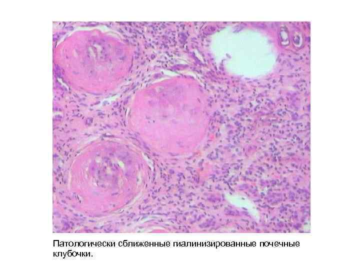 Патологически сближенные гиалинизированные почечные клубочки. 