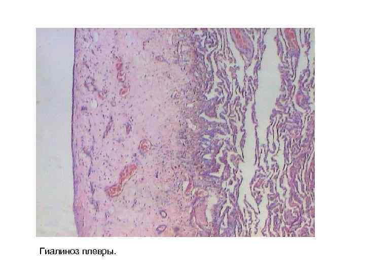 Гиалиноз плевры. 