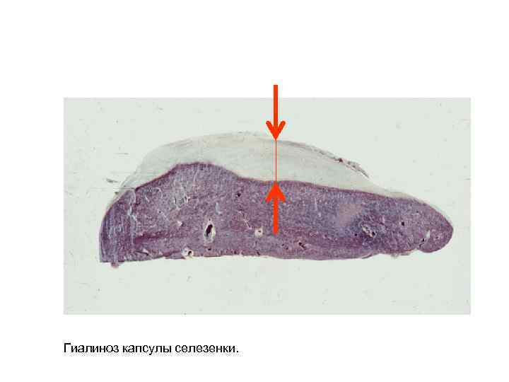 Гиалиноз капсулы селезенки. 