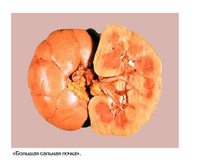  «Большая сальная почка» . 