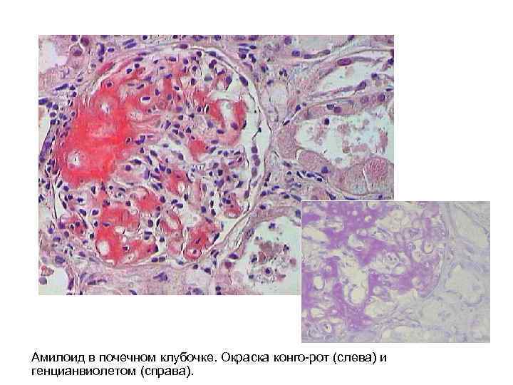 Амилоид в почечном клубочке. Окраска конго-рот (слева) и генцианвиолетом (справа). 