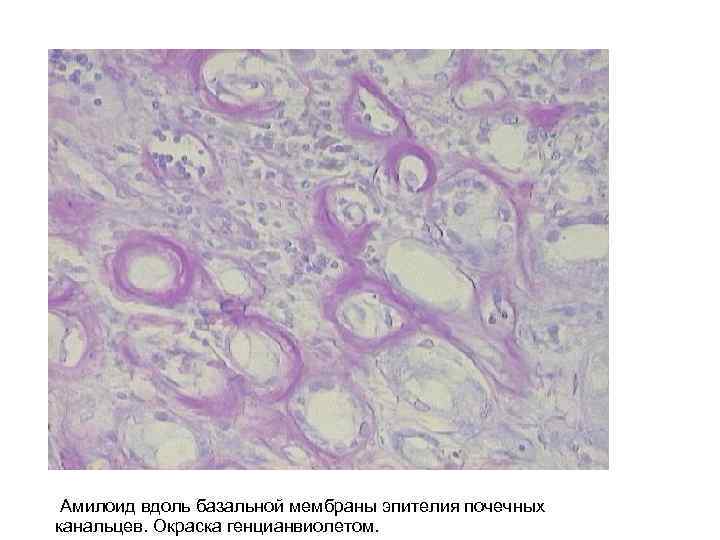  Амилоид вдоль базальной мембраны эпителия почечных канальцев. Окраска генцианвиолетом. 