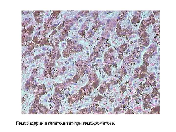 Гемосидерин в гепатоцитах при гемохроматозе. 