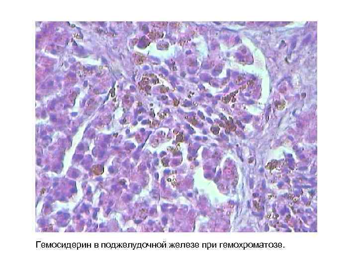 Гемосидерин в поджелудочной железе при гемохроматозе. 