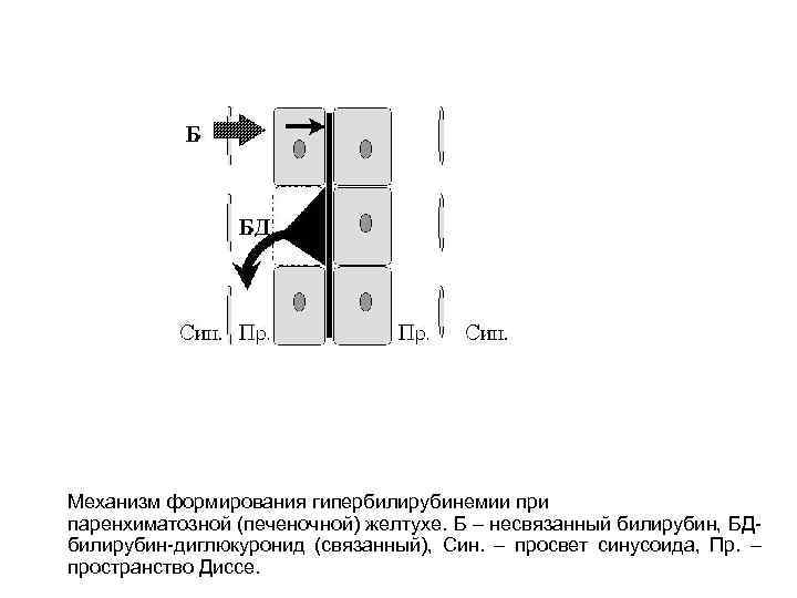 Механизм формирования гипербилирубинемии при паренхиматозной (печеночной) желтухе. Б – несвязанный билирубин, БД- билирубин-диглюкуронид (связанный),