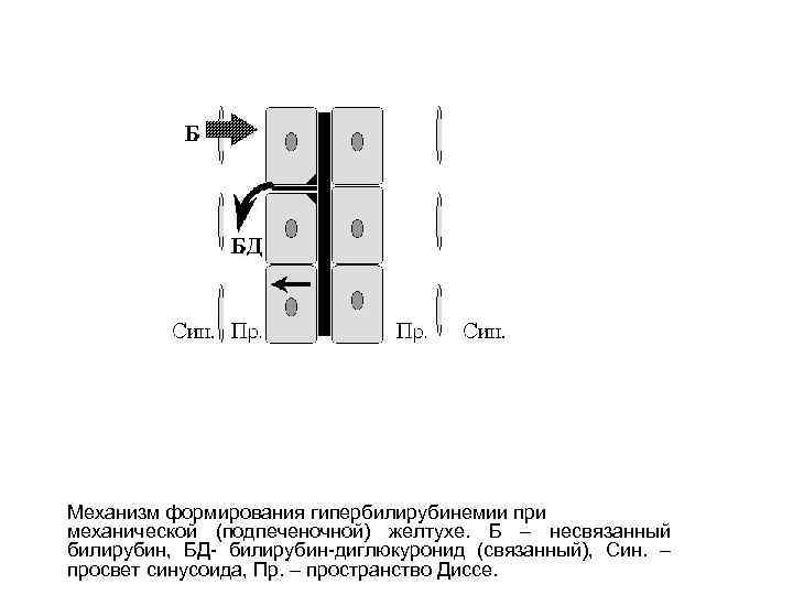 Механизм формирования гипербилирубинемии при механической (подпеченочной) желтухе. Б – несвязанный билирубин, БД- билирубин-диглюкуронид (связанный),