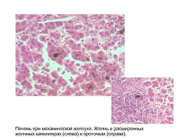 Печень при механической желтухе. Желчь в расширенных желчных капиллярах (слева) и проточках (справа). 