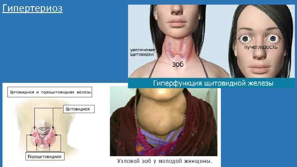 Гипертериоз 