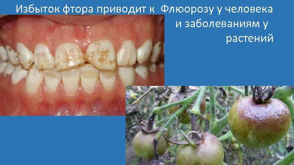 Избыток фтора приводит к Флюорозу у человека и заболеваниям у растений 