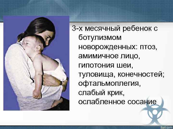 3 -х месячный ребенок с ботулизмом новорожденных: птоз, амимичное лицо, гипотония шеи, туловища, конечностей;