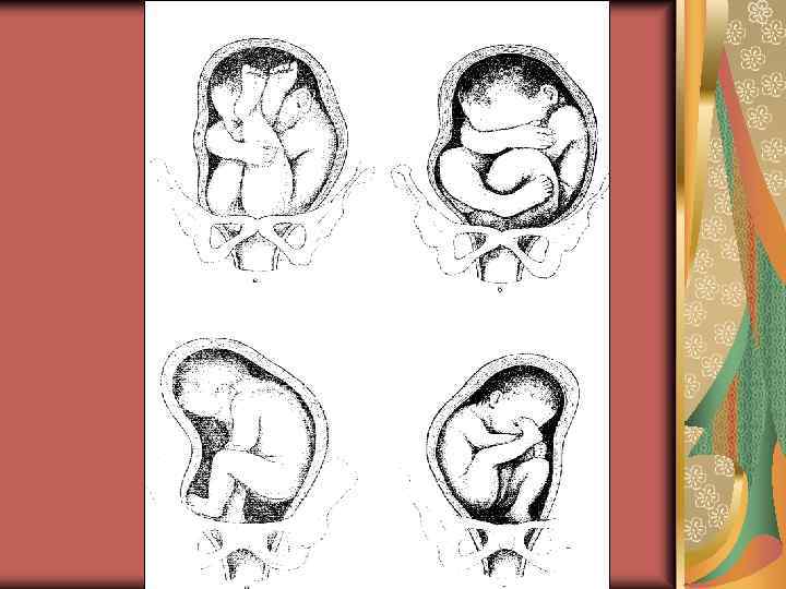 32 недели тазовое предлежание. Роды в тазовом продольном предлежании. Предлежание головное продольное на 32 неделе. Продольное головное предлежание плода 36 недель. 32 Неделя беременности головное предлежание.