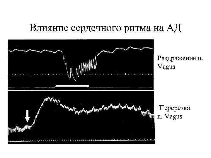 Влияние сердечного ритма на АД Раздражение n. Vagus Перерезка n. Vagus 