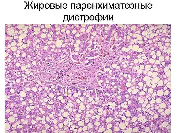 Жировые паренхиматозные дистрофии 