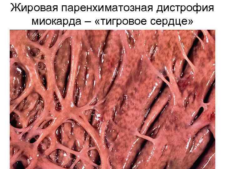 Жировая паренхиматозная дистрофия миокарда – «тигровое сердце» 