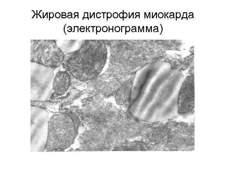 Жировая дистрофия миокарда (электронограмма) 