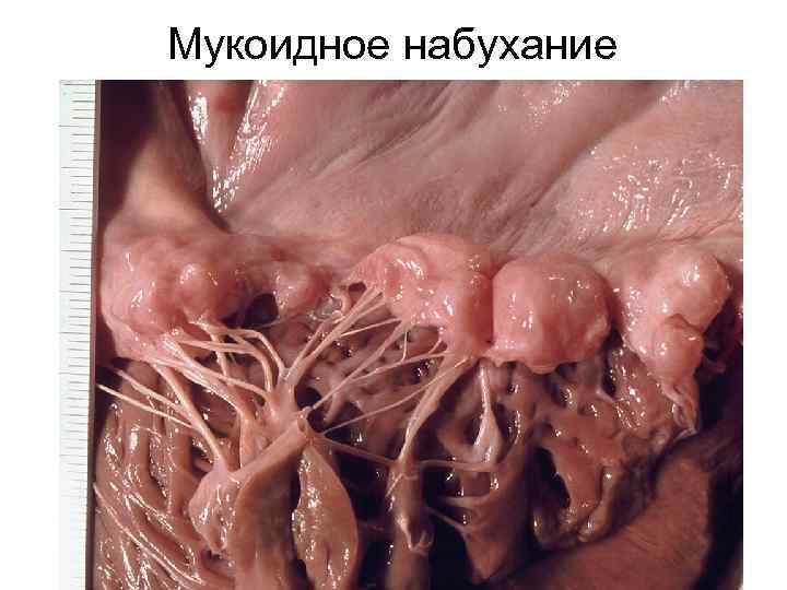 Мукоидное набухание 