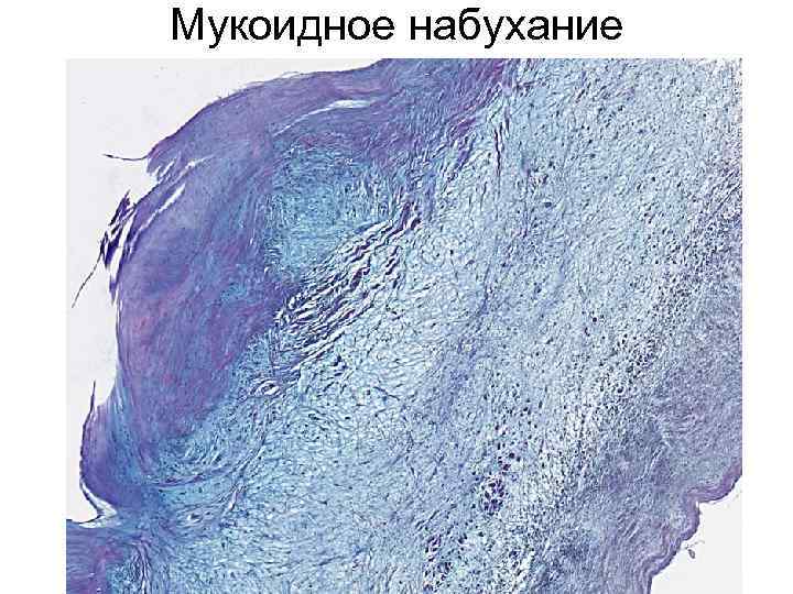 Мукоидное набухание 