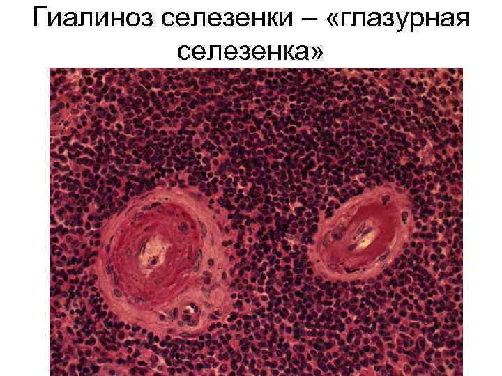 Гиалиноз селезенки – «глазурная селезенка» 