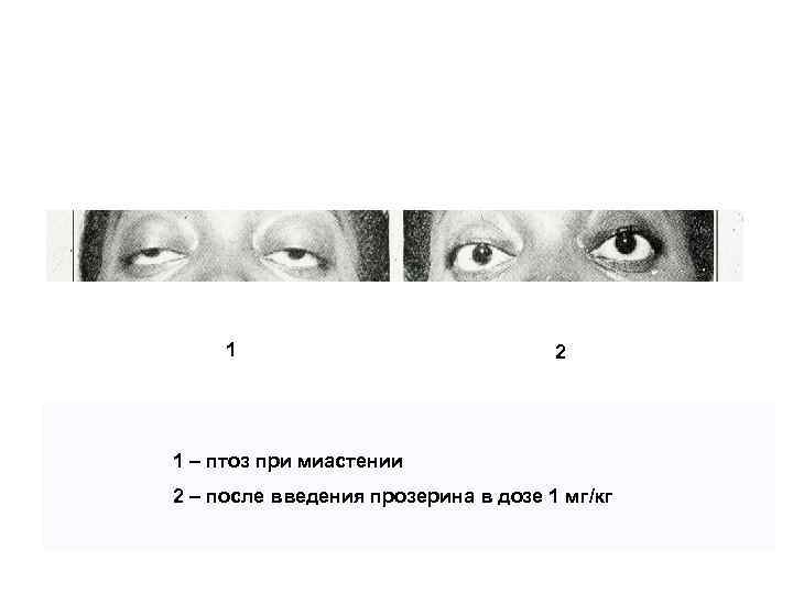 1 2 1 – птоз при миастении 2 – после введения прозерина в дозе