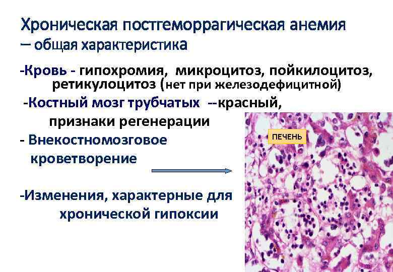 Хронические заболевания крови. Постгеморрагическая анемия картина крови. Костный мозг при хронической постгеморрагической анемии. Картина крови при хронической постгеморрагической анемии. Хронический миелолейкоз гистология.