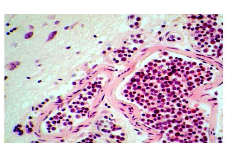 Thrombocytosis латынь. Тромбоцитоз при анемии. Тромбоцитоз.