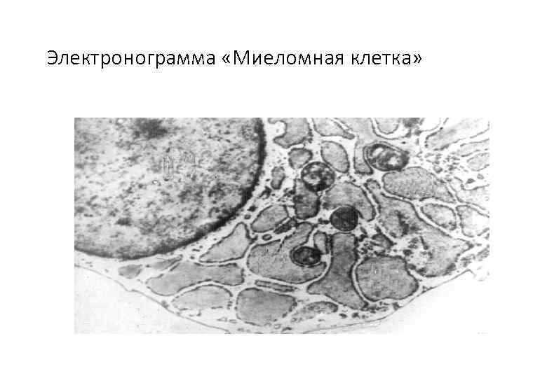 Миеломная болезнь картина крови