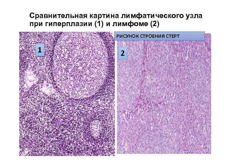 Реактивная гиперплазия лимфоузла. Гиперплазия лимфатического узла микропрепарат. Неспецифическая гиперплазия лимфатического узла микропрепарат. Реактивная фолликулярная гиперплазия лимфоузлов гистология. Лимфоидная ткань микропрепарат.
