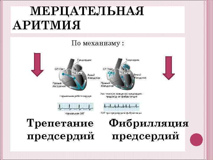 МЕРЦАТЕЛЬНАЯ АРИТМИЯ По механизму : Трепетание предсердий Фибрилляция предсердий 