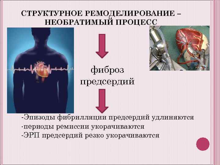 СТРУКТУРНОЕ РЕМОДЕЛИРОВАНИЕ – НЕОБРАТИМЫЙ ПРОЦЕСС фиброз предсердий -Эпизоды фибрилляции предсердий удлиняются -периоды ремиссии укорачиваются