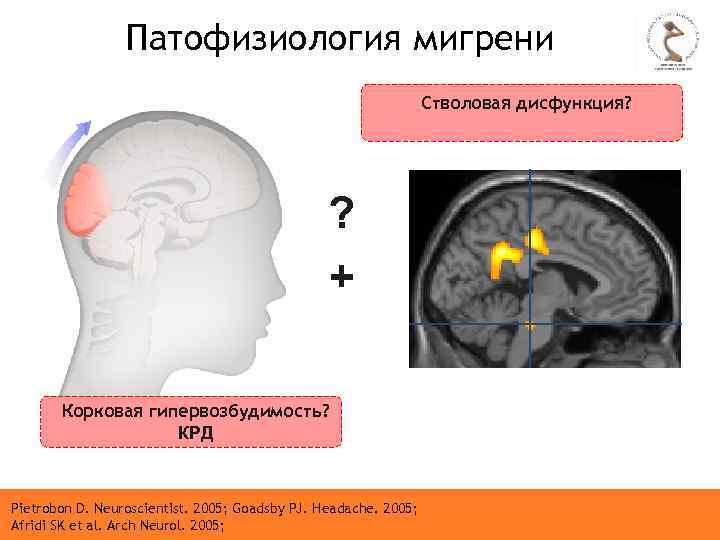 Патофизиология мигрени Стволовая дисфункция? ? + Корковая гипервозбудимость? КРД Pietrobon D. Neuroscientist. 2005; Goadsby