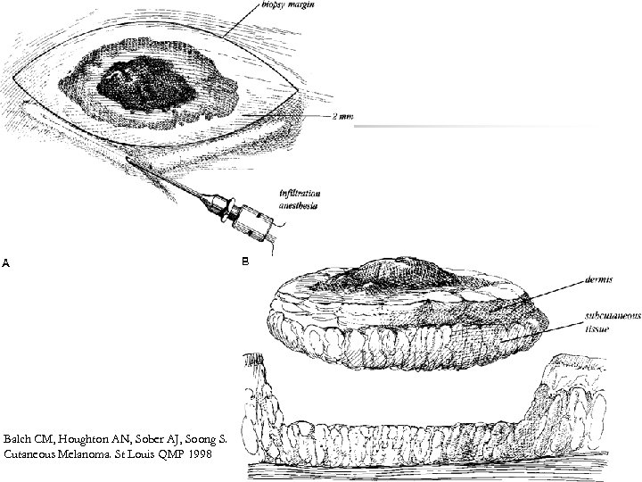 Balch CM, Houghton AN, Sober AJ, Soong S. Cutaneous Melanoma. St Louis QMP 1998