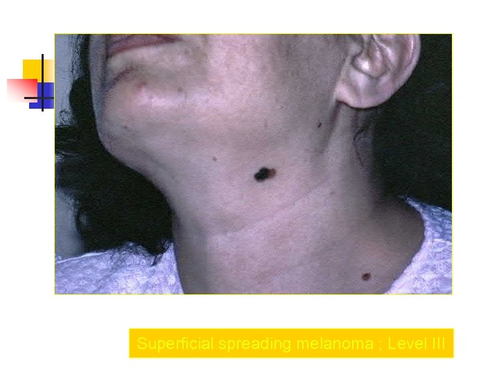 Superficial spreading melanoma ; Level III 